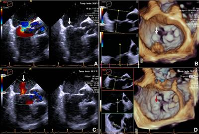 First in human neochordae retensioning for recurrence of mitral regurgitation after neochord procedure